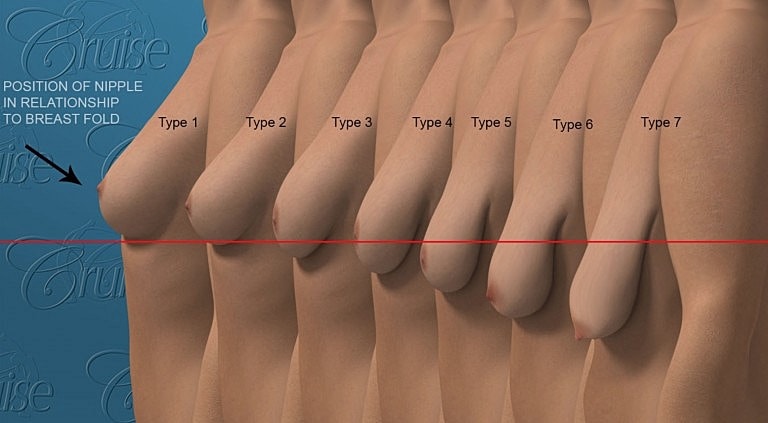 Breast types showing nipple positioning and relationship.