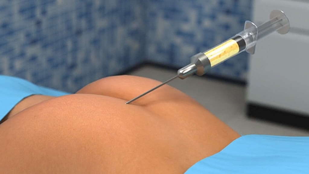 Syringe injection on a patient's back.
