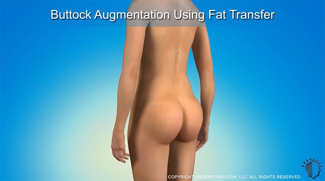 Buttock augmentation demonstration using fat transfer technique.
