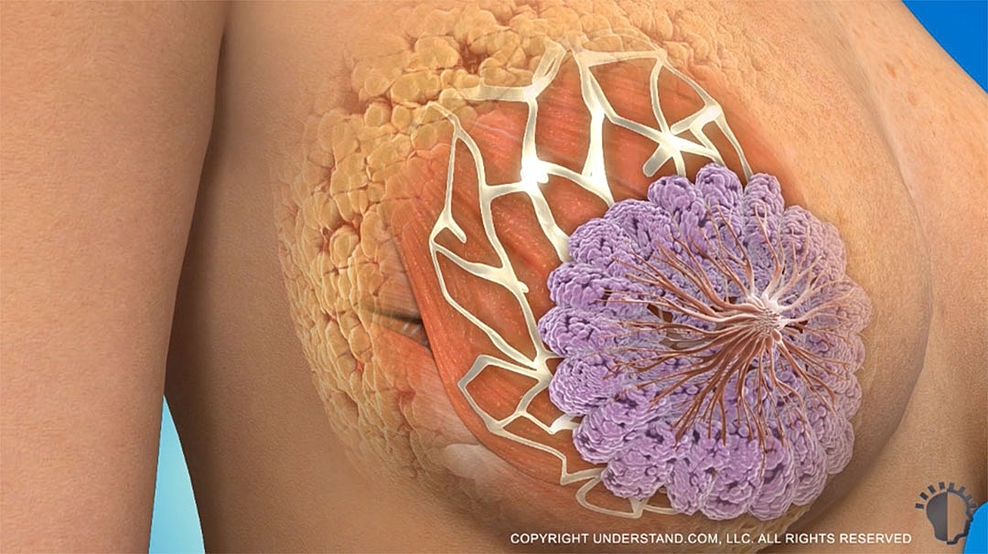Illustration of breast tissue and possible cancer cells.