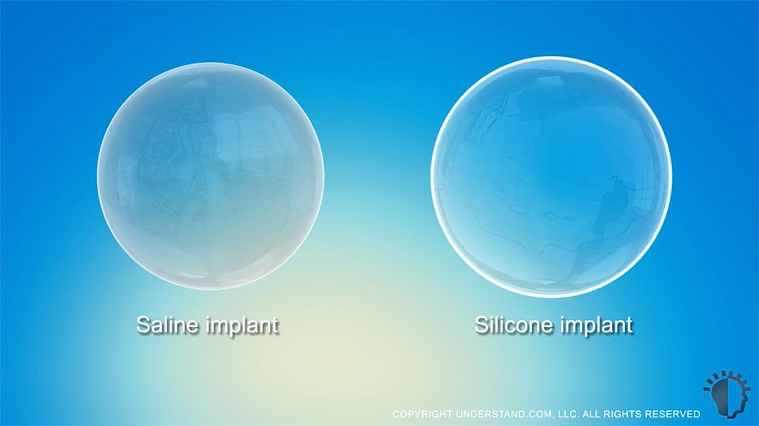 Saline and silicone breast implant comparison.