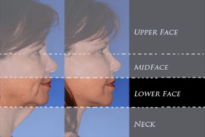 4-regions-lower-face