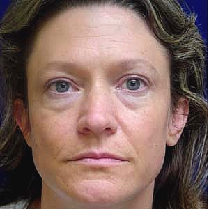 Before female lower blepharoplasty - front view