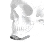 Square Jaw Chin Implant - Anatomic view