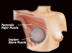 Breast implant above muscle