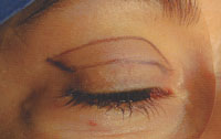 Incision for upper eyelid excess skin removal
