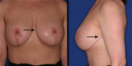 Classic breast lift incision - too long with too much scarring