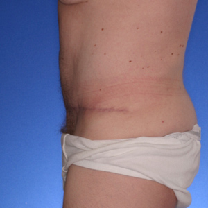 After extended abdominoplasty - side view