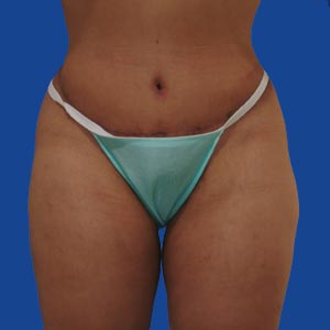 After extended tummy tuck - front view
