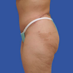 After extended tummy tuck - side view