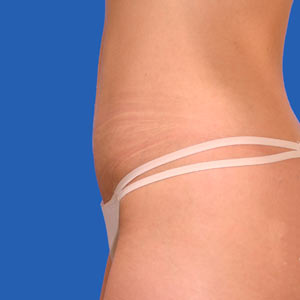 After mini tummy tuck - side view
