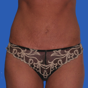 After standard tummy tuck female - front view