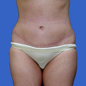 After standard abdominoplasty female - front view