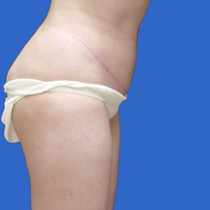 After standard abdominoplasty female - side view