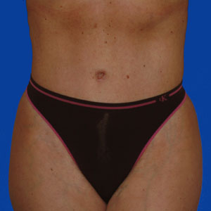 Mother of two after tummy tuck - front view