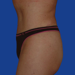 Mother of two after tummy tuck - side view