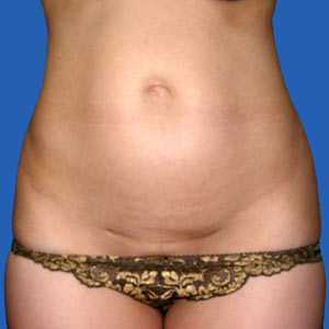 Before mini tummy tuck - front view