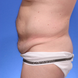 Before extended abdominoplasty - side view