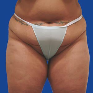 Before extended tummy tuck - front view