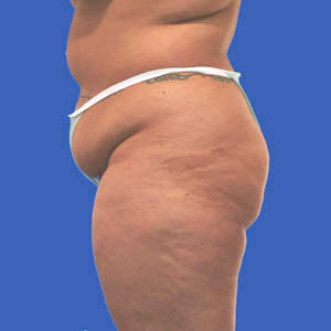 Before extended tummy tuck - side view