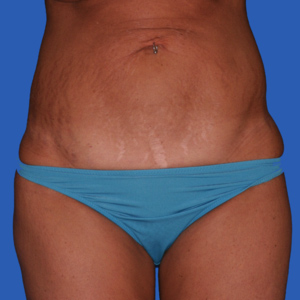 Before standard tummy tuck female - front view