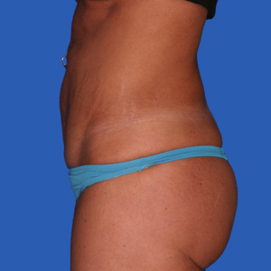 Before standard tummy tuck - side view