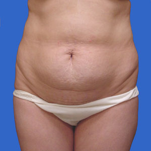 Before standard abdominoplasty female - front view