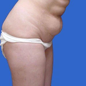 Before standard abdominoplasty female - side view