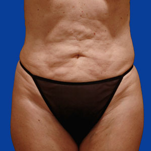 Mother of two before tummy tuck - front view