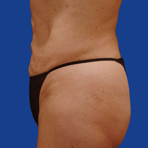 Mother of two before tummy tuck - side view