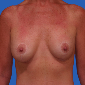 Asymmetrical breasts after lift and implants - front view