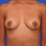 Anchor breast lift incision
