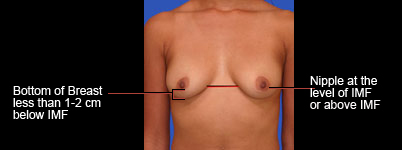 Heavier breasts that may require a lift