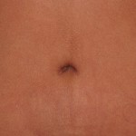 Joseph T Cruise, MD's tummy tuck belly button incision