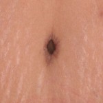 Circular incision around belly button