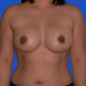 Breasts after capsular contracture correction - front view