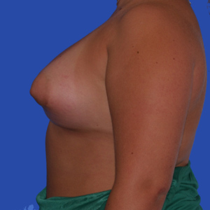 breast-augmentation_plak-32_lat_faq_IMG_0288a