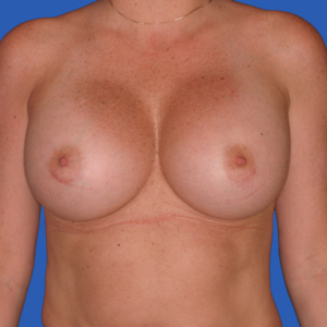 After dramatic breast implants - front view