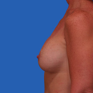 Asymmetrical breasts after lift and implants - side view