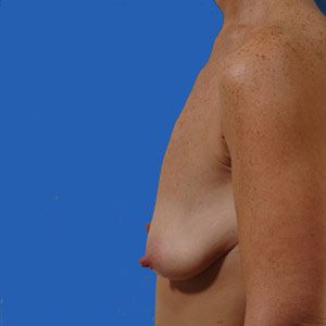 Asymmetrical breasts before lift and implants - side view