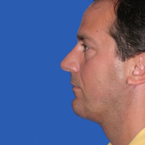 After man's chin implant and neck lift - side view