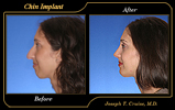 Before and After Nose Surgery Newport Beach