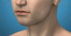 Animated chin implant - male