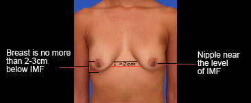 Ideal nipple placement for donut breast lift