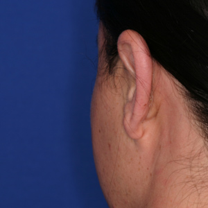 Female after otoplasty - rear view
