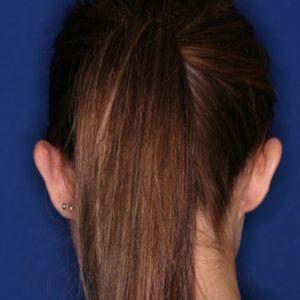 Before ear surgery female - rear view