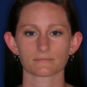Protruding ears before otoplasty female - front view