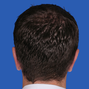 Male after otoplasty - rear view