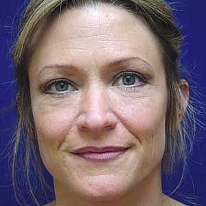 After female lower blepharoplasty - front view
