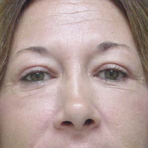 After lower eyelid skin removal - front view